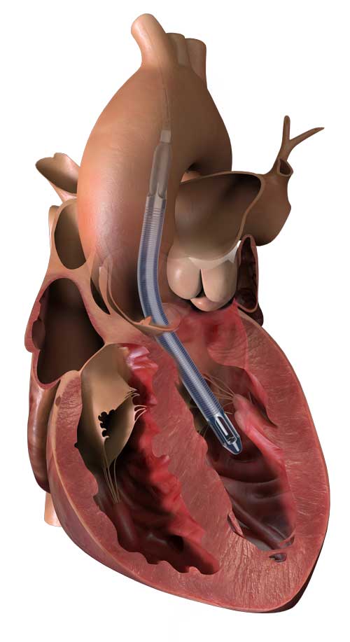 Image of the Impella 5.5 with SmartAssist in an illustration of a heart